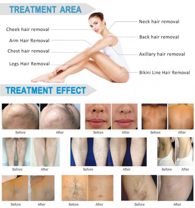 Permanent Diode Laser Hair Removal Machine 755 808 1064Nm Medical Beauty Equipment 7