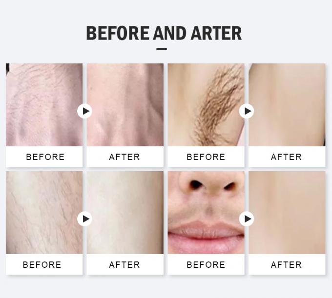 Máquina de láser de diodo de titanio de hielo longitud de onda triple 755 808 1064Nm Diodo láser de depilación 11